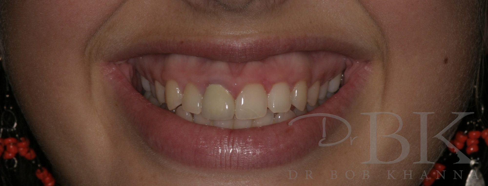 Before Gummy Smile Treatment gummy smile surgery reading PT 1 - AFTER