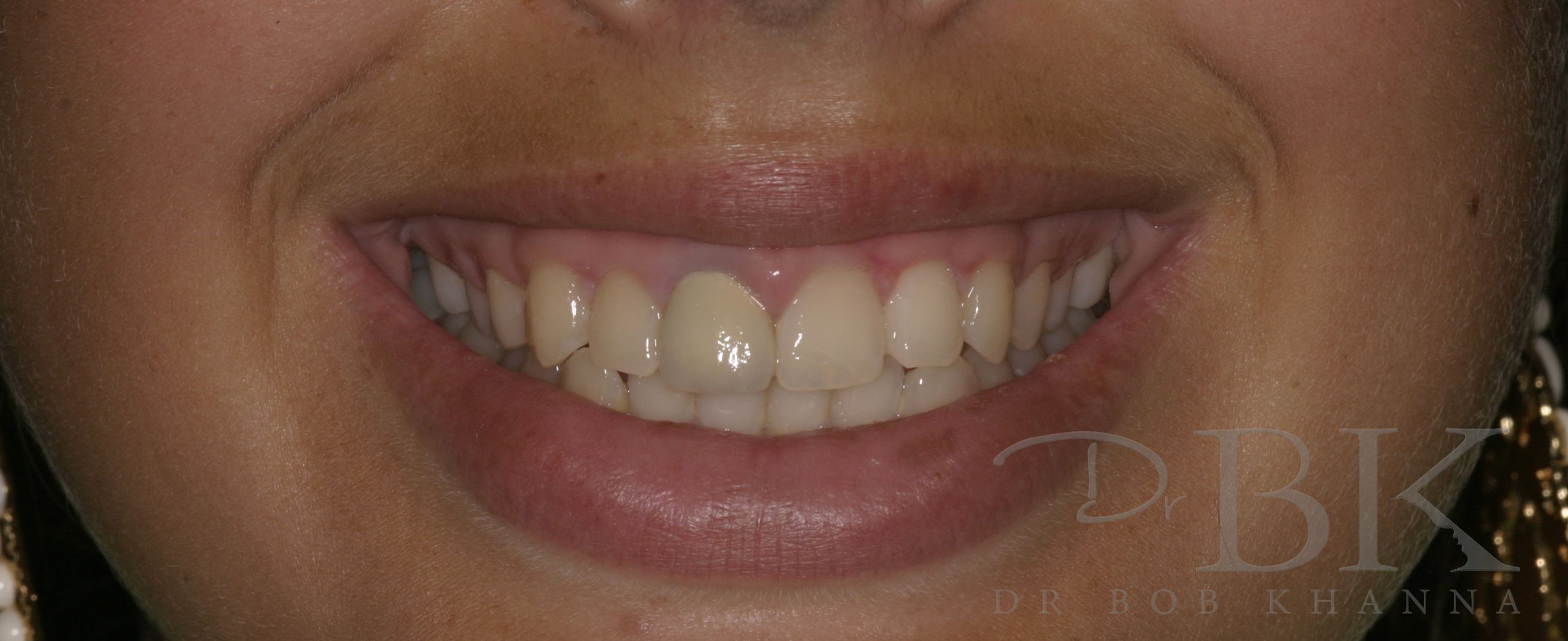 After Gummy Smile Treatment gummy smile surgery reading PT 1 - BEFORE