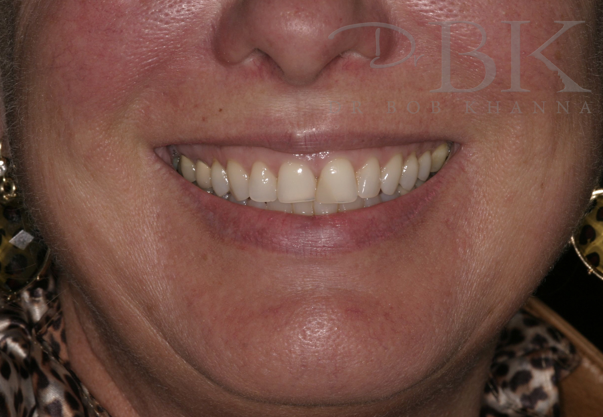 After Gummy Smile Treatment After Gummy Smile Treatment