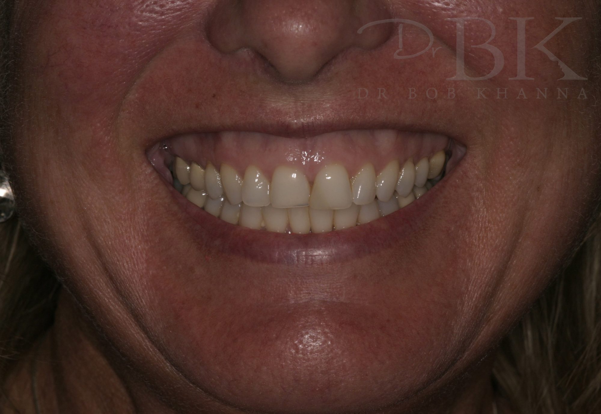 Before Gummy Smile Treatment