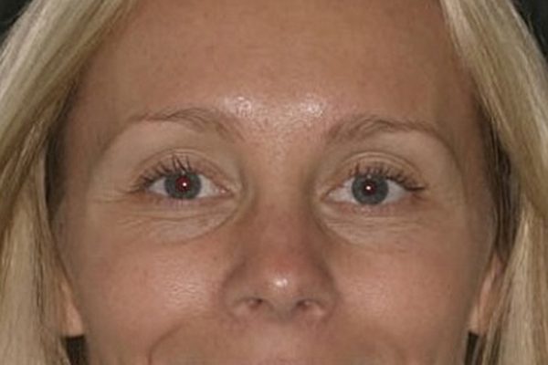 After Gummy Smile Treatment After Gummy Smile Treatment