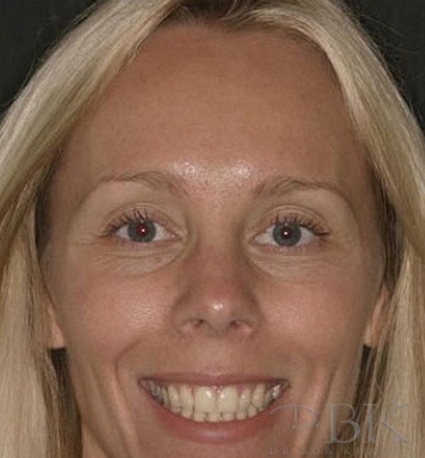 After Gummy Smile Treatment After Gummy Smile Treatment