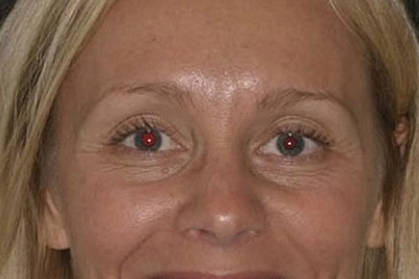 Before Gummy Smile Treatment Before Gummy Smile Treatment