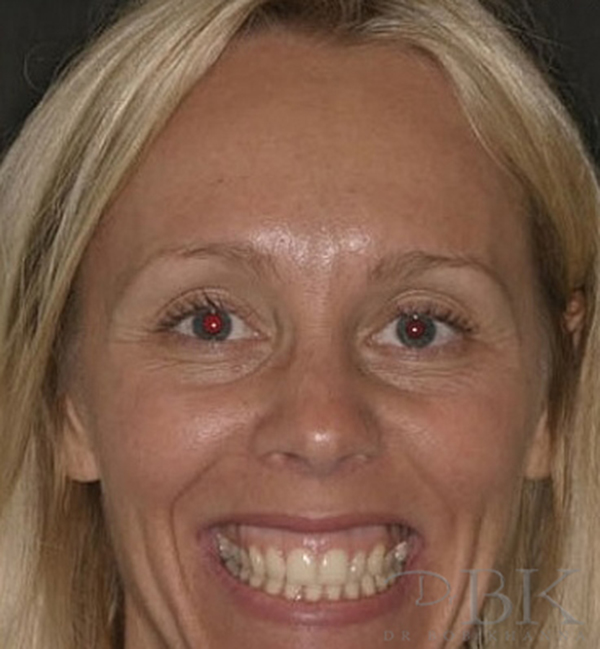 Before Gummy Smile Treatment Before Gummy Smile Treatment