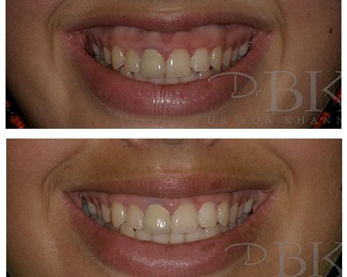 Before & After Gummy Smile Treatment Before & After Gummy Smile Treatment