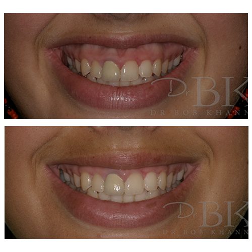 Before & After Gummy Smile Treatment
