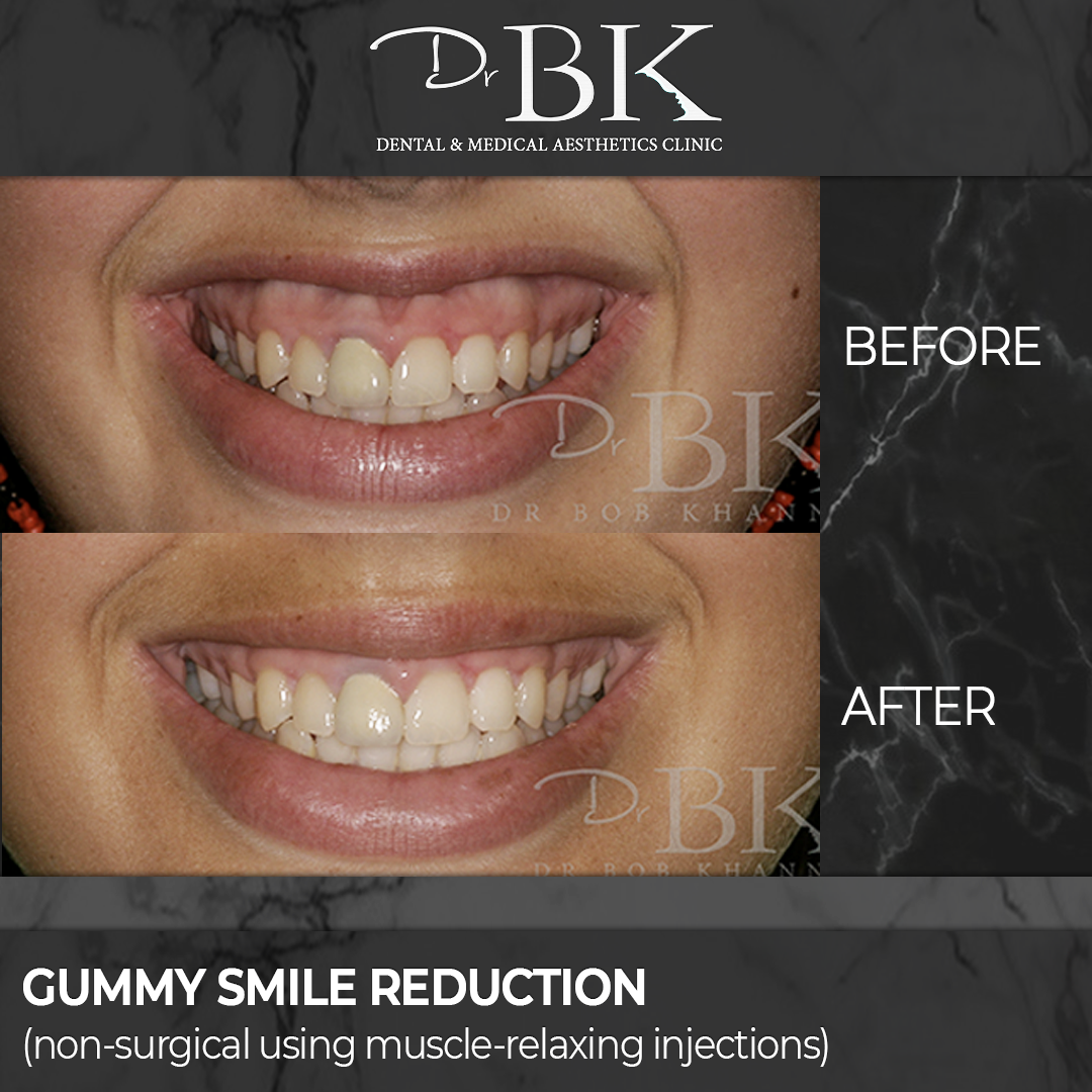 Gingival display treatment (gummy smile reduction)