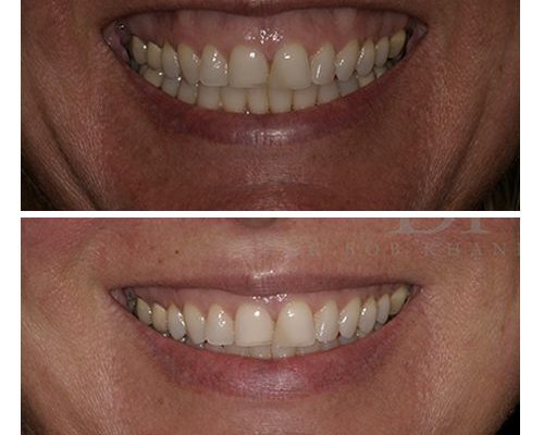 Before & After Gummy Smile Treatment Before & After Gummy Smile Treatment