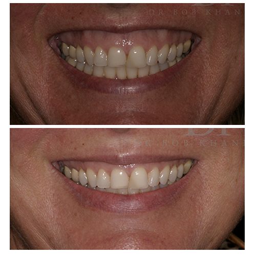 Before & After Gummy Smile Treatment Before & After Gummy Smile Treatment