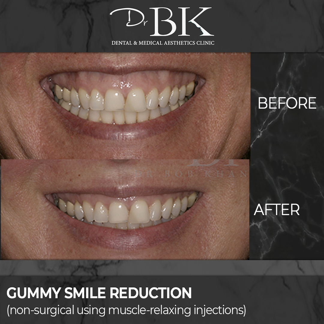 Gingival display treatment (gummy smile reduction)