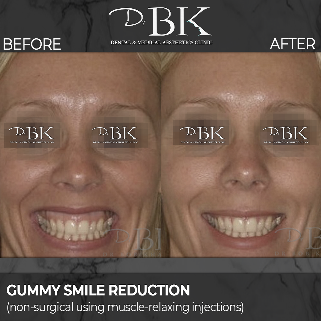Gingival display treatment (gummy smile reduction)