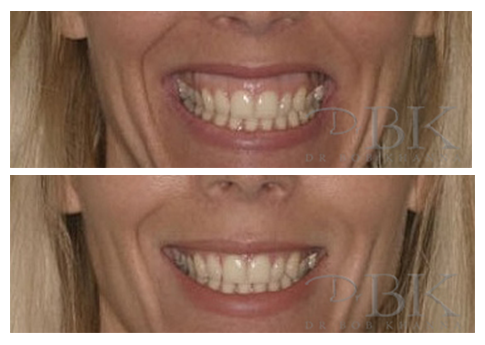 Before & After Gummy Smile Treatment Before & After Gummy Smile Treatment