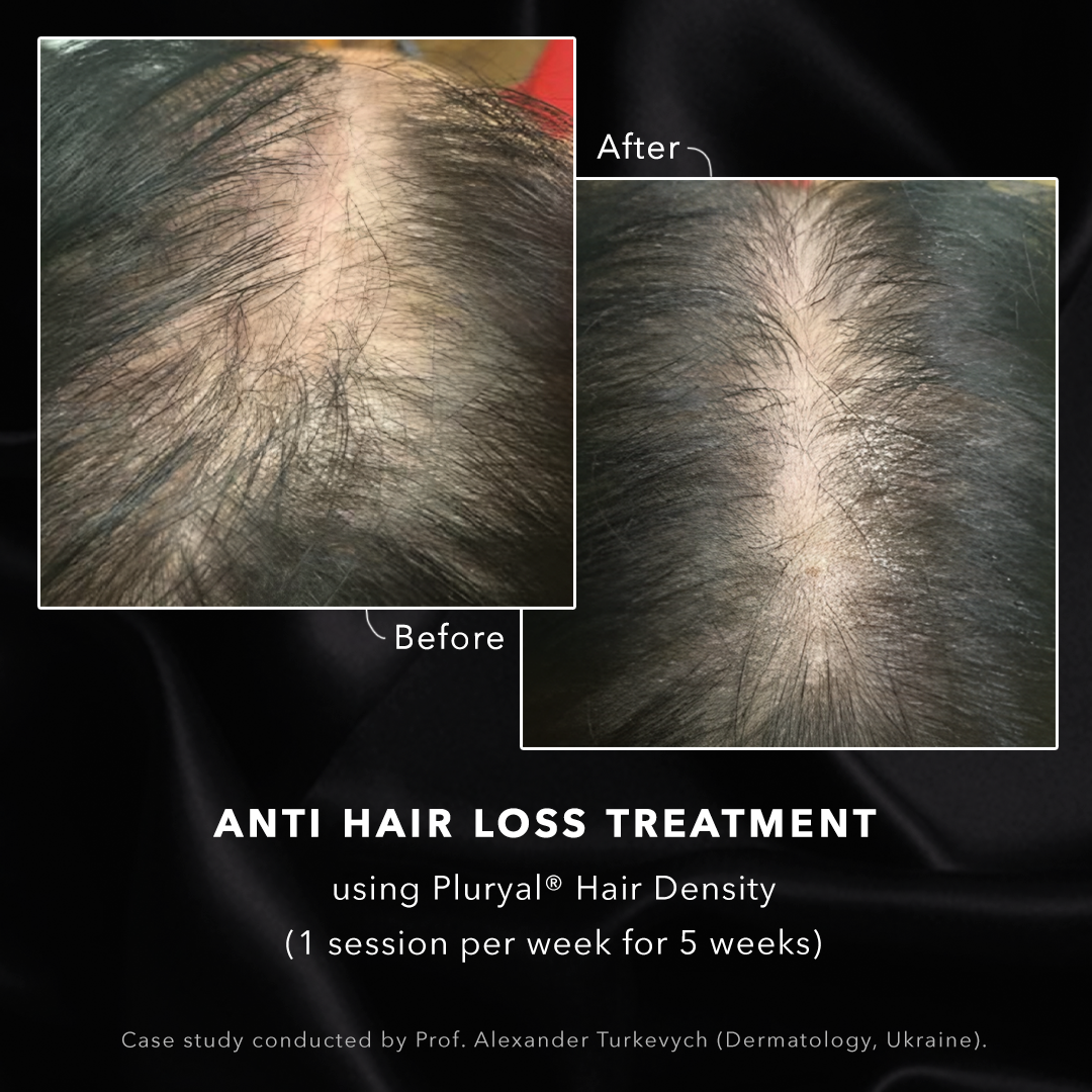 Before and after - anti hair loss treatment at DrBK Reading