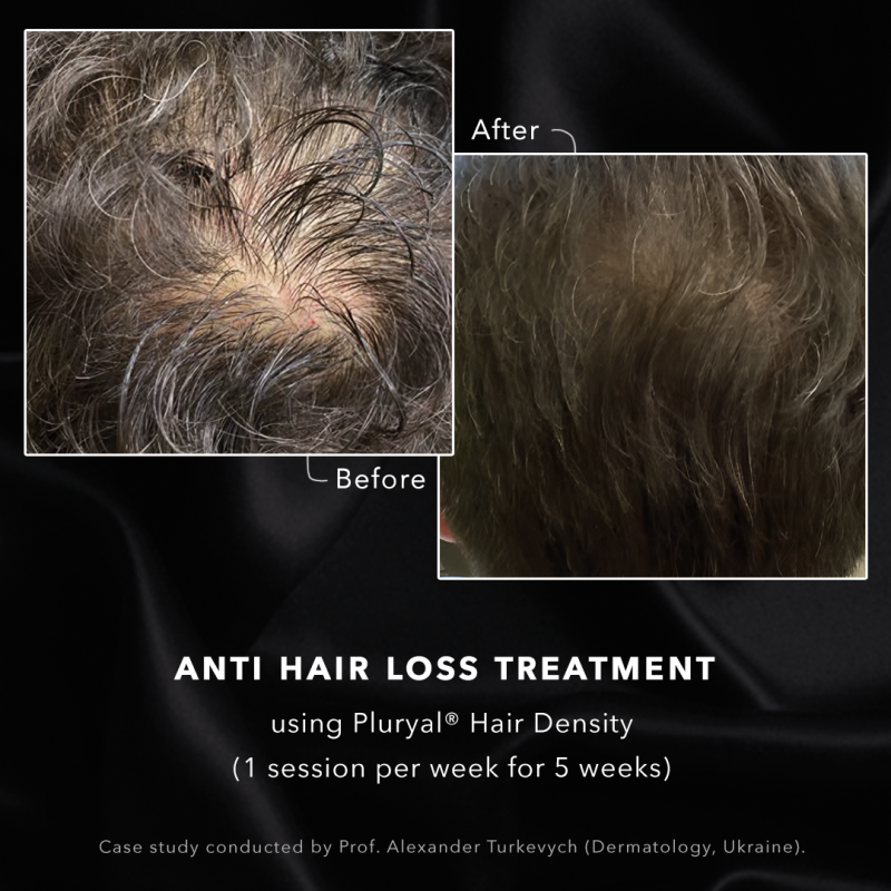 Anti hair loss treatment at DrBK Reading