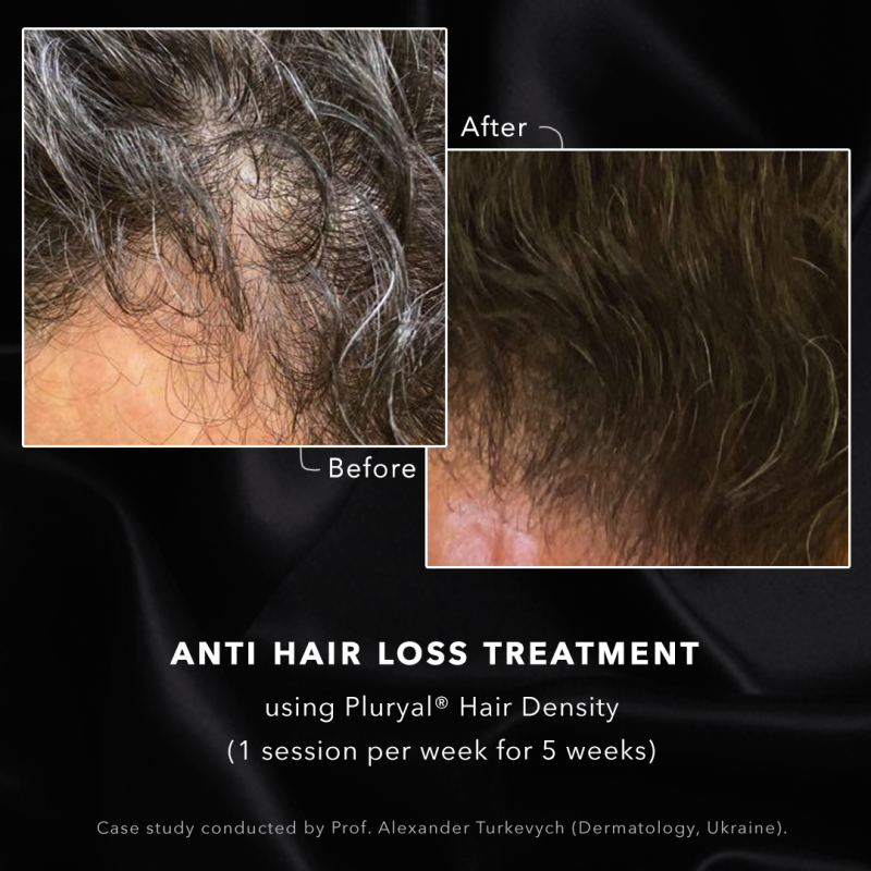 Anti hair loss treatment at DrBK Reading
