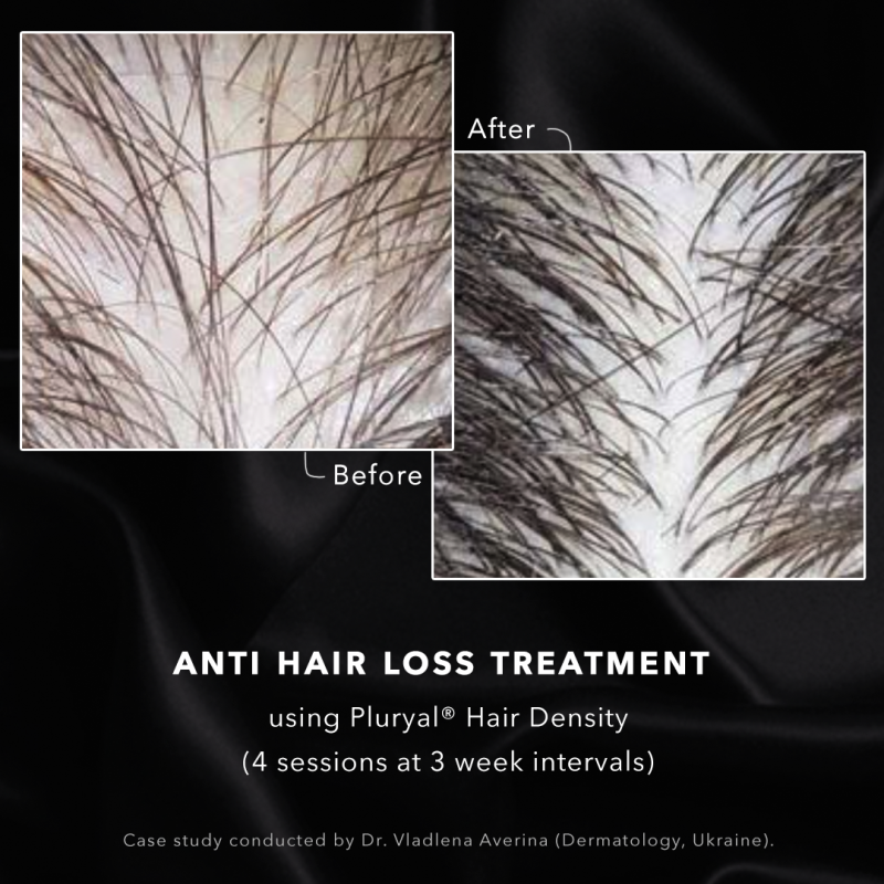 Anti hair loss treatment at DrBK Reading