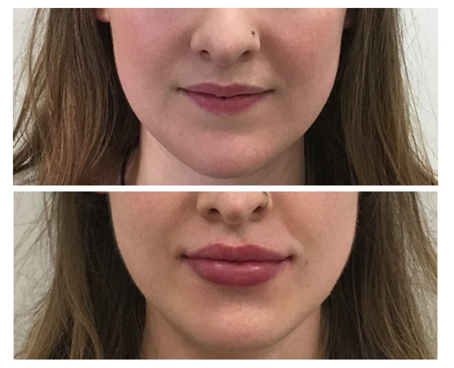 Before & After HeartLips