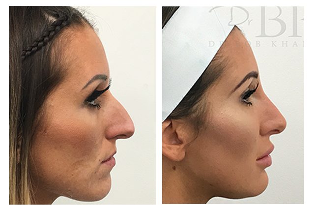 Full Face Treatment: Tear Troughs, Cheeks, Nose, Chin, Lips