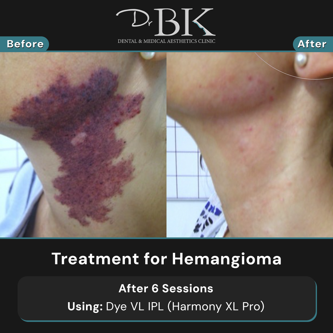 hemangioma-iPLDyeVL hemangioma-iPLDyeVL