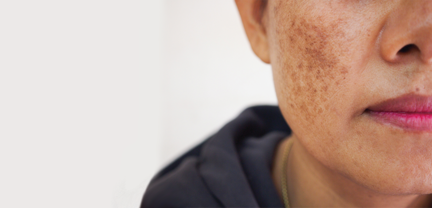 hyperpigmentation treatment at drbk