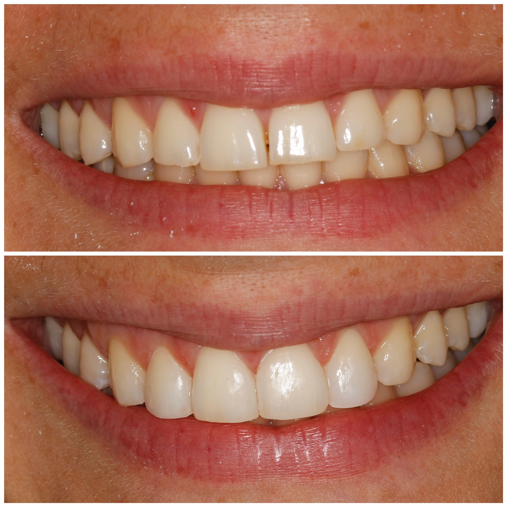 Dental Veneers DrBK Cosmetic Dentist & Aesthetics Clinic in Reading