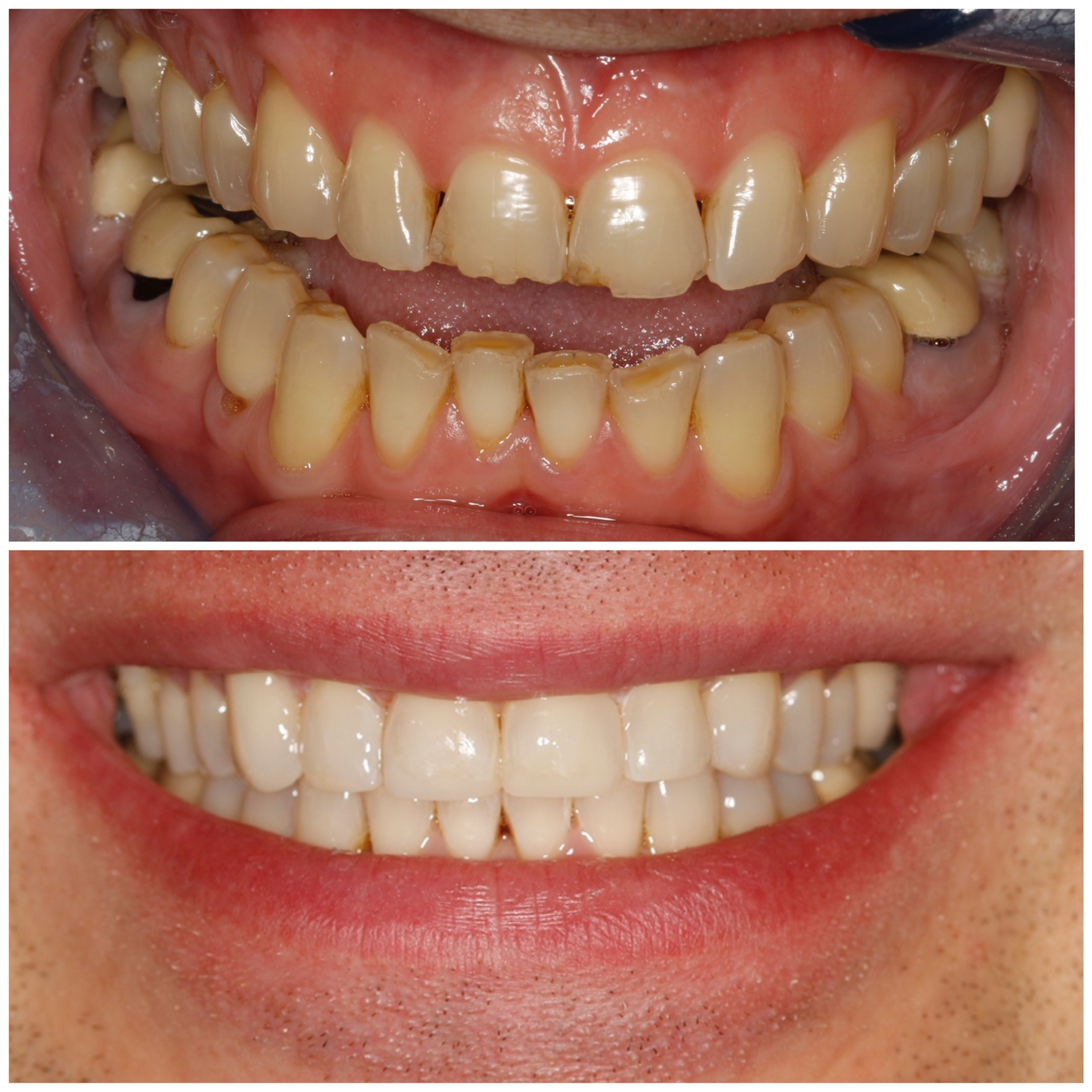 Composite Bonding Before & After