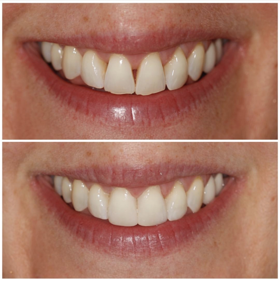 Dental Veneers - DrBK Cosmetic Dentist & Aesthetics Clinic ...