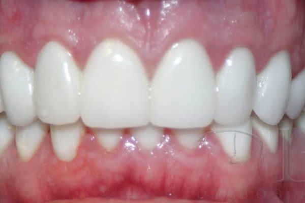 After Full Smile Makeover at DrBK implant and crown after