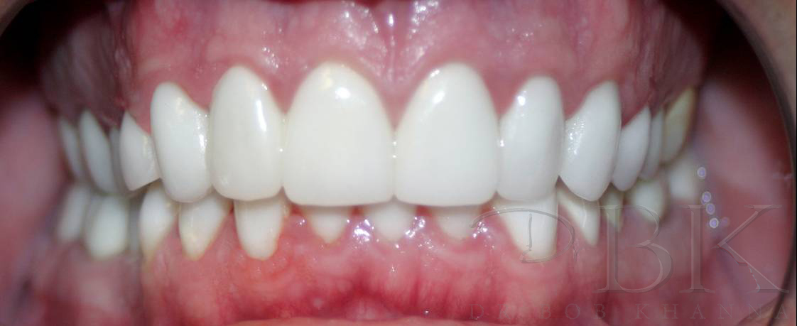 implant and crown after