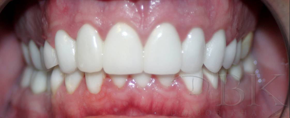 After Full Smile Makeover at DrBK implant and crown after