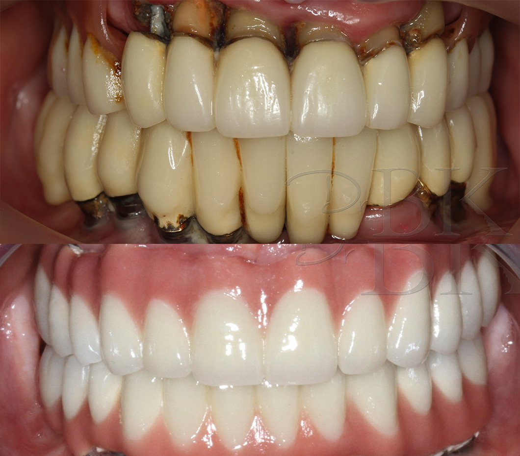 implant-retained-dentures at DrBK in Reading