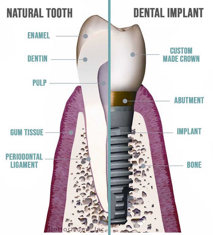 Normal Tooth Vs Implant