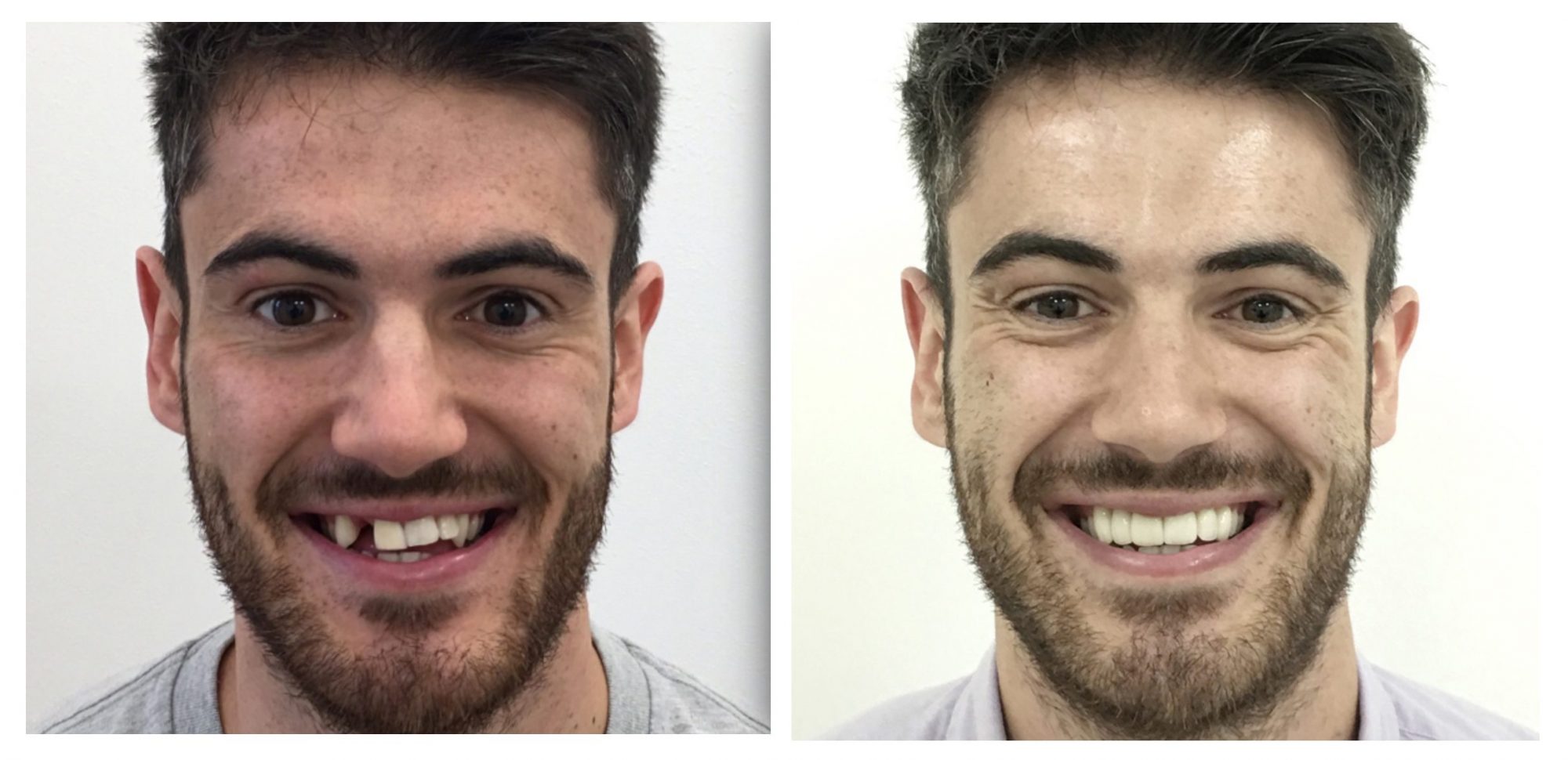 Before & After Veneers