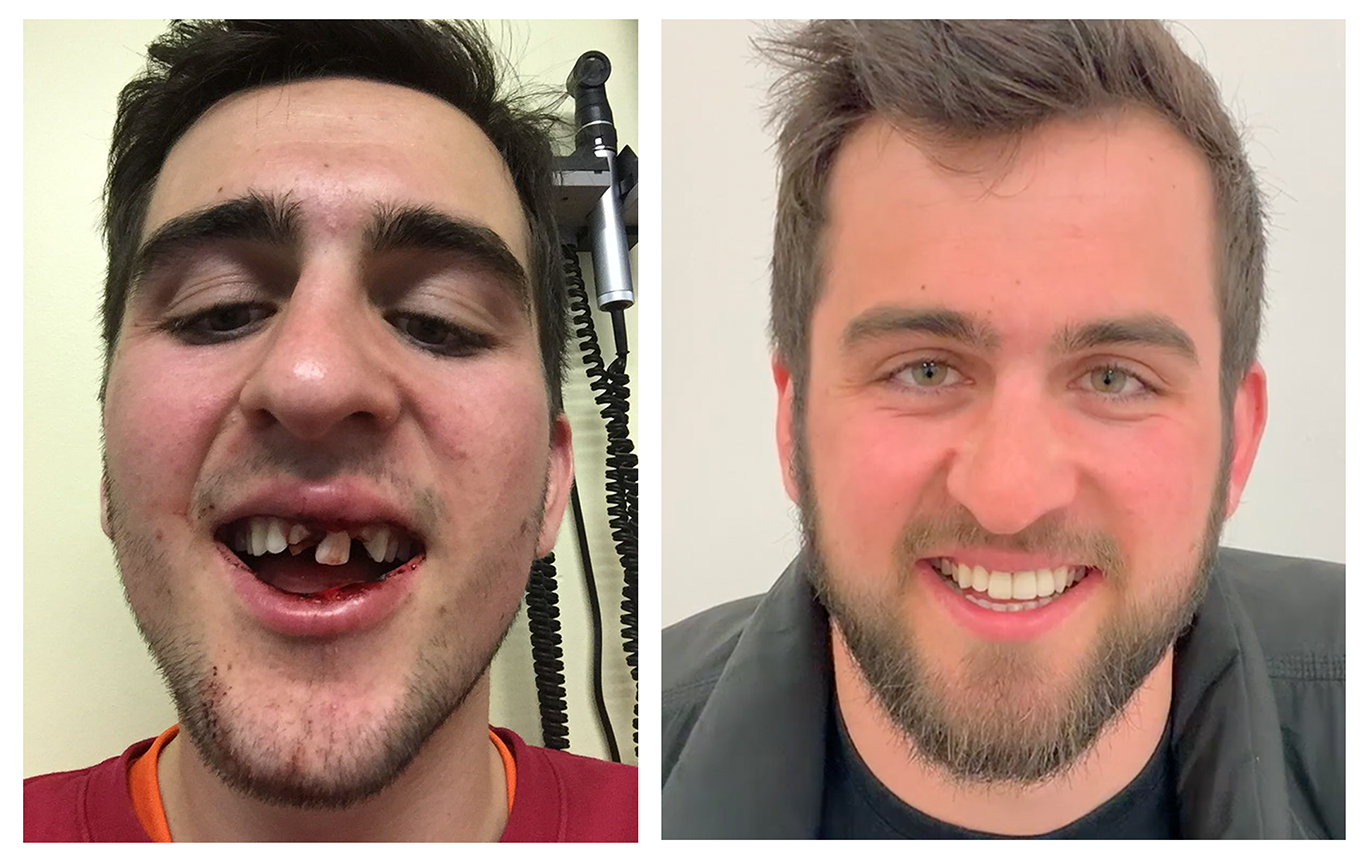 Before and after dental treatment at DrBK