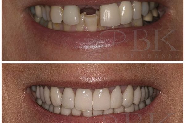Before & After Dental Implant Before & After Dental Implant