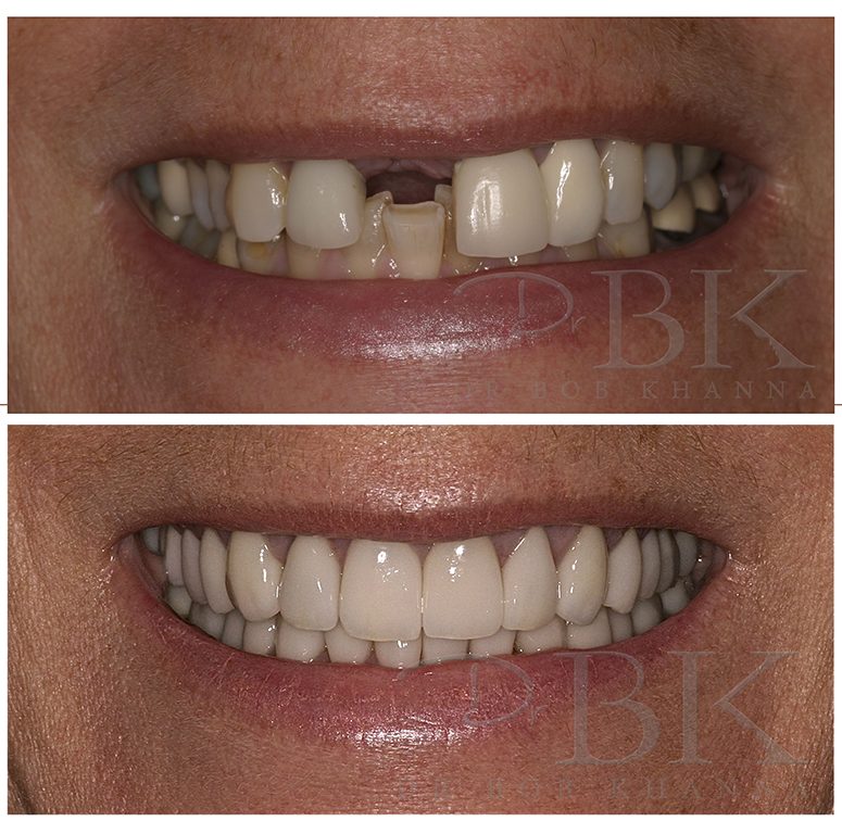 Before & After Dental Implant Before & After Dental Implant