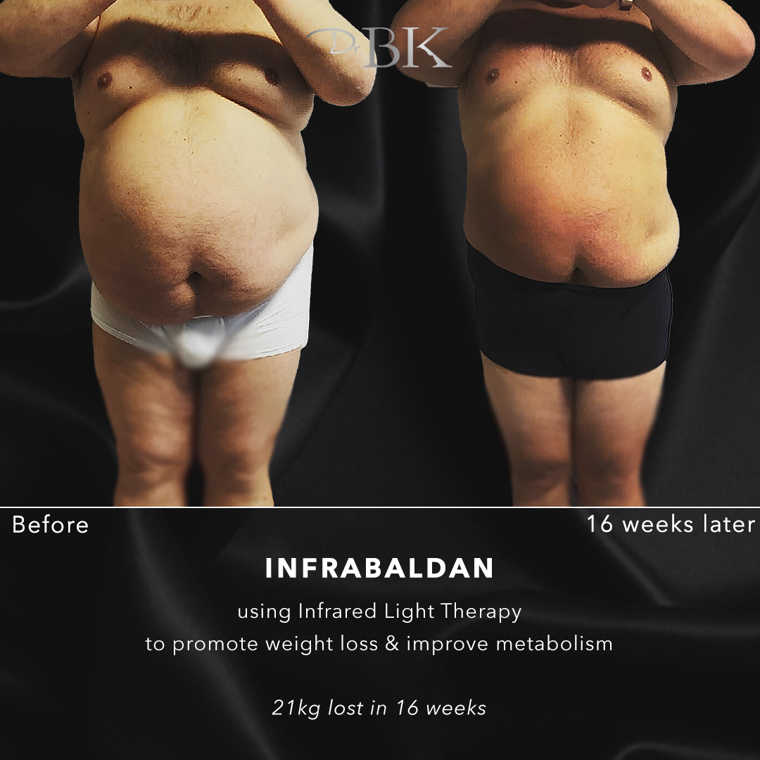 InfraBaldan laser treatment for fat loss - Photo showing patient with 21kg loss in 16 weeks