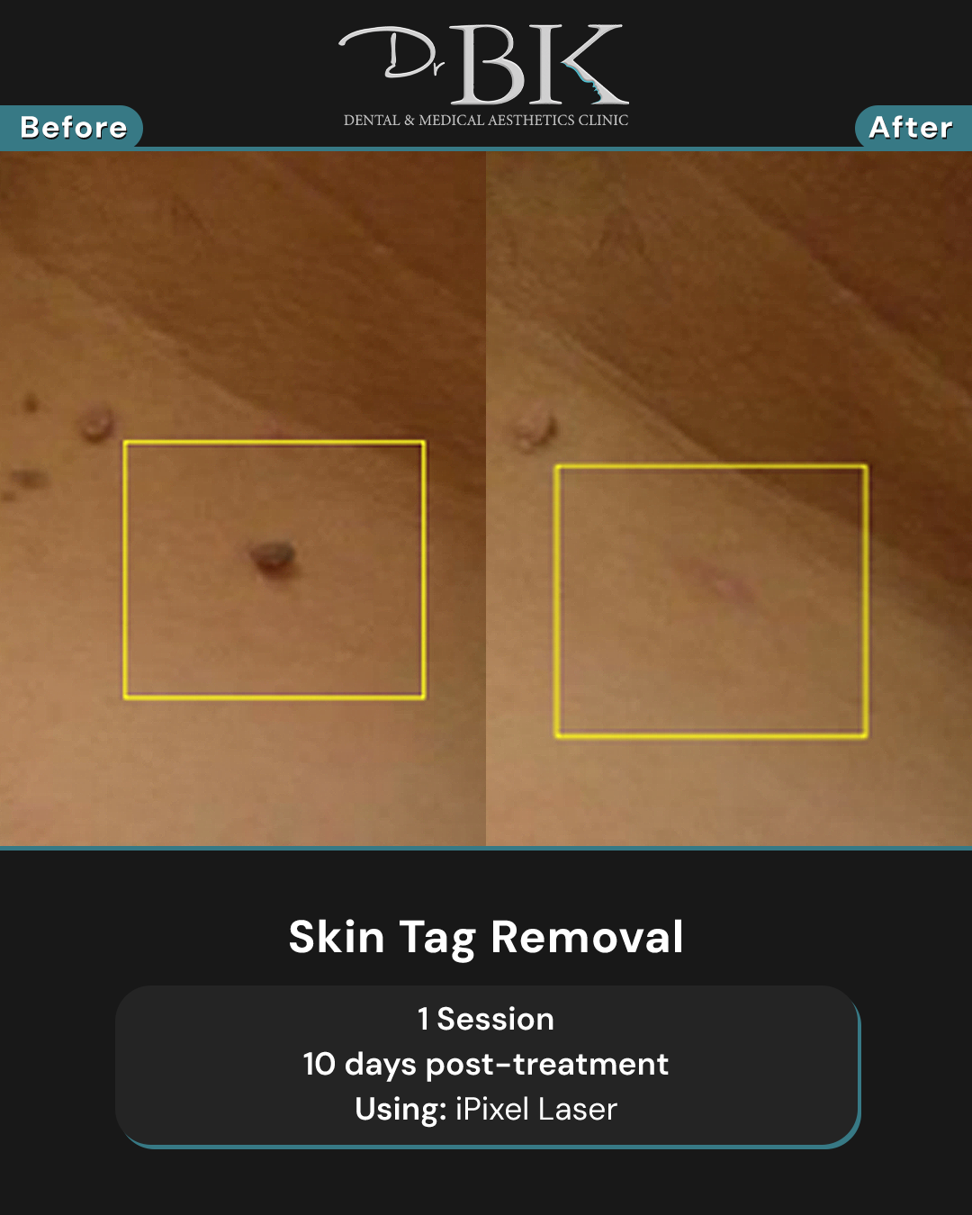 ipixel-skintagsB+A ipixel-skintagsB+A