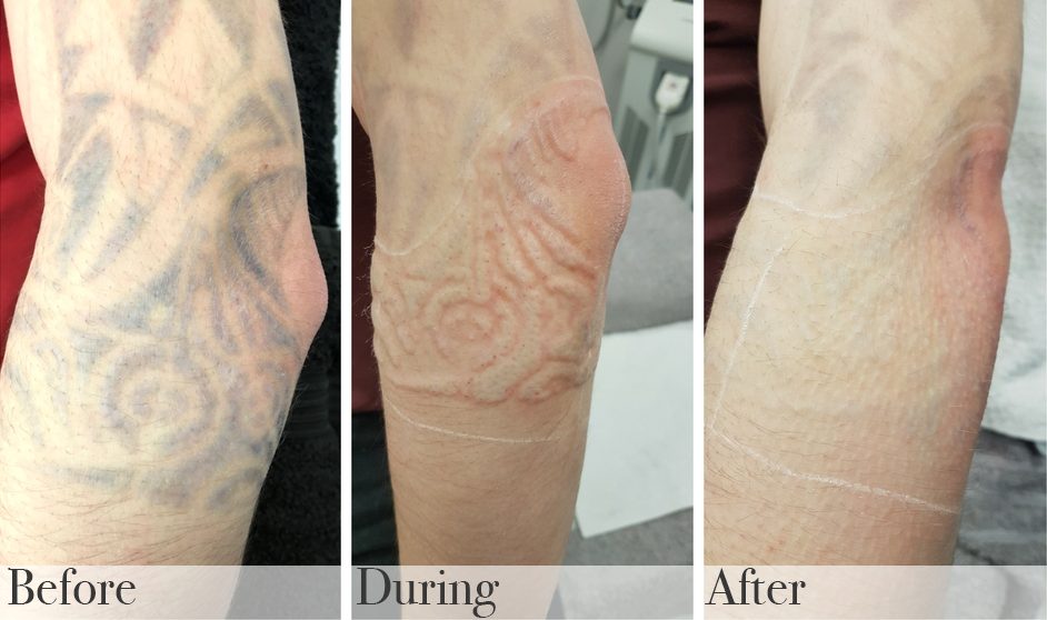 Before, during & after Laser Tattoo Removal at DrBK