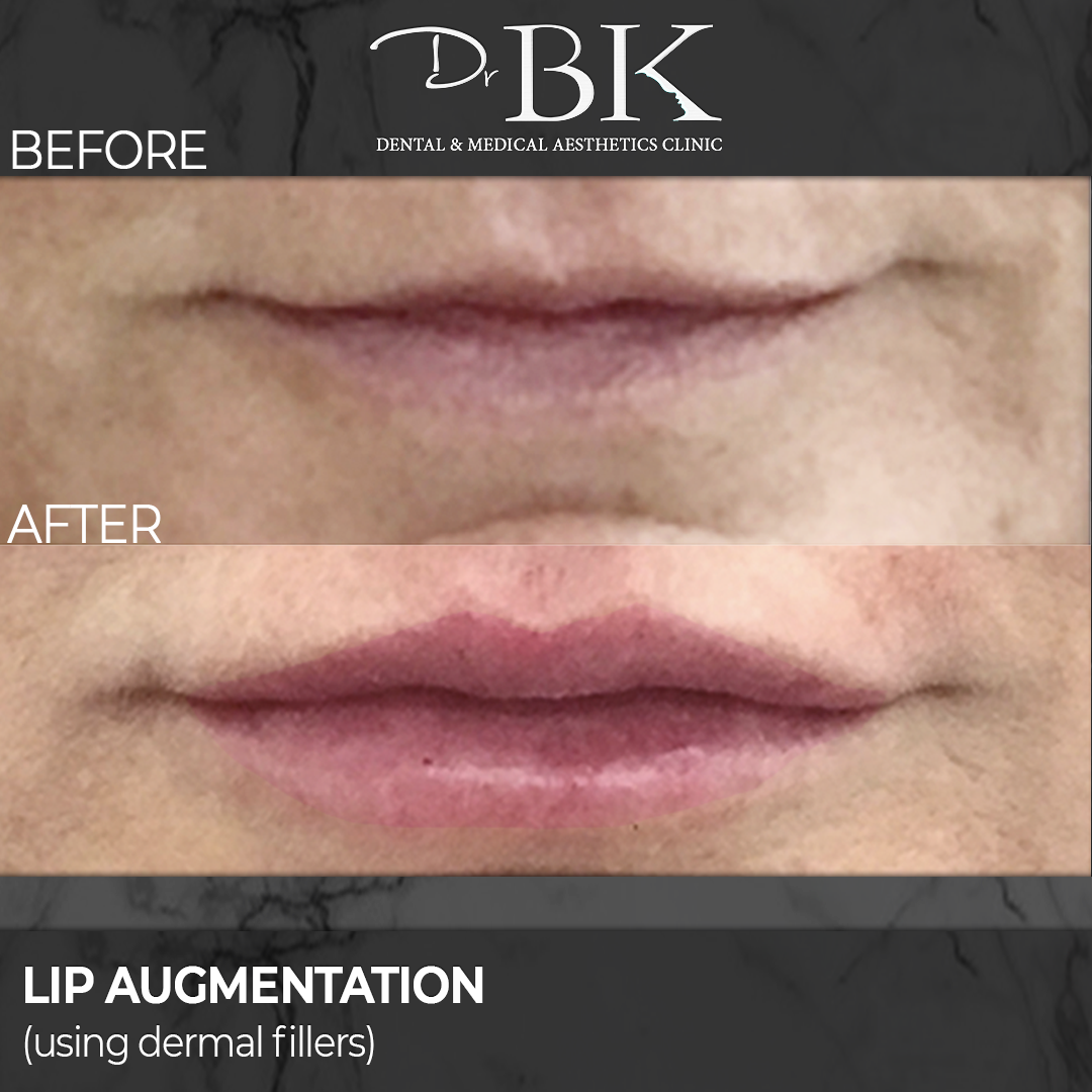 Lip Augmentation: Before & After (Subtle)