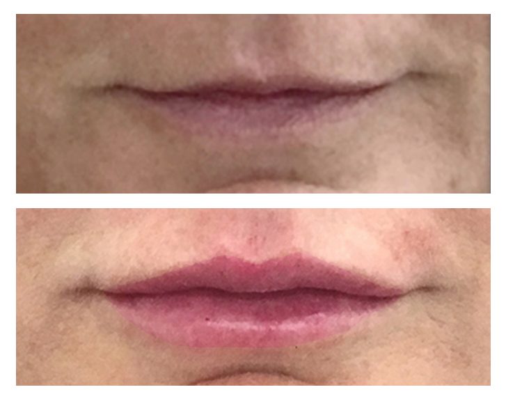 Lip Fillers & Heart Lips® DrBK Cosmetic Dentist & Aesthetics Clinic