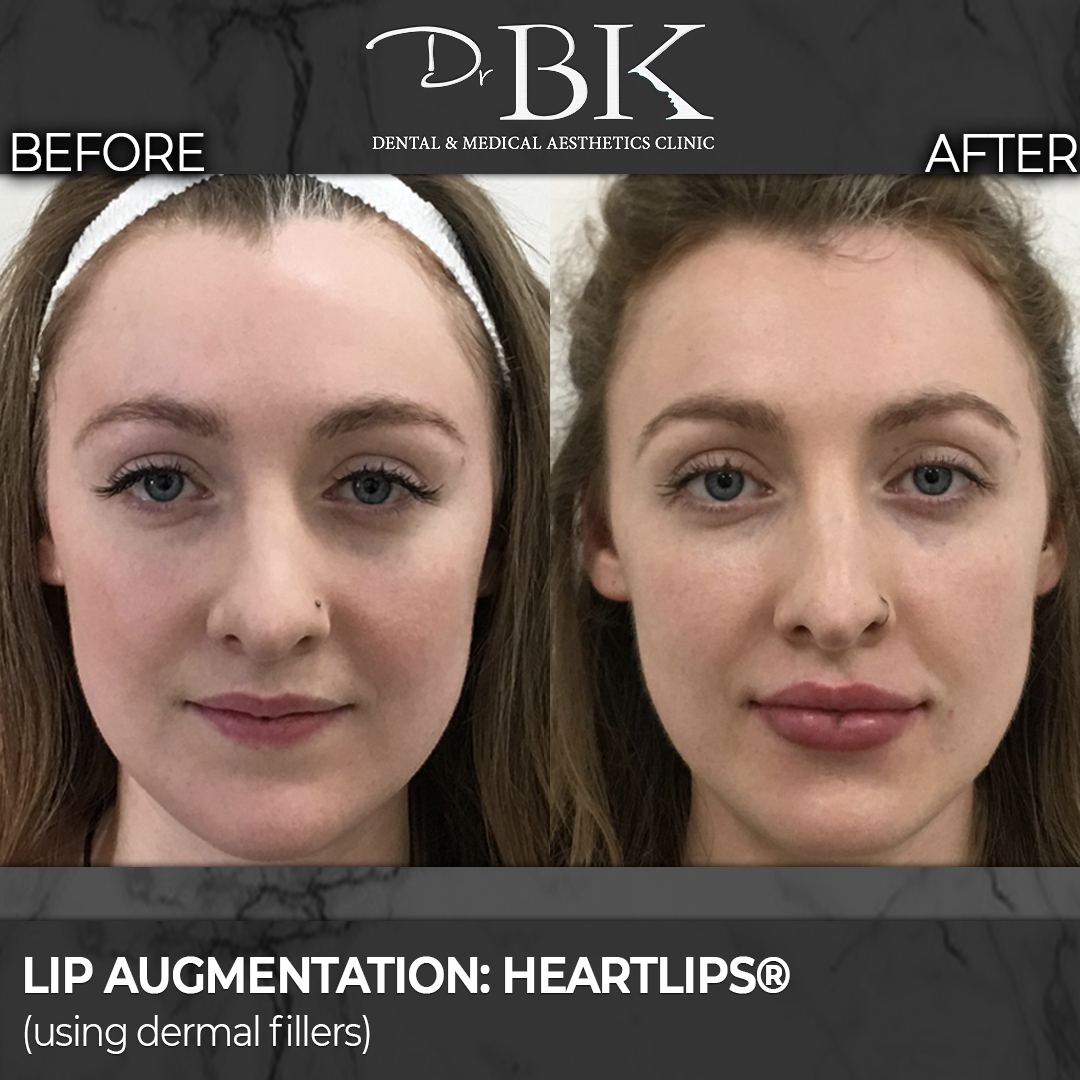 Lip augmentation - HeartLips