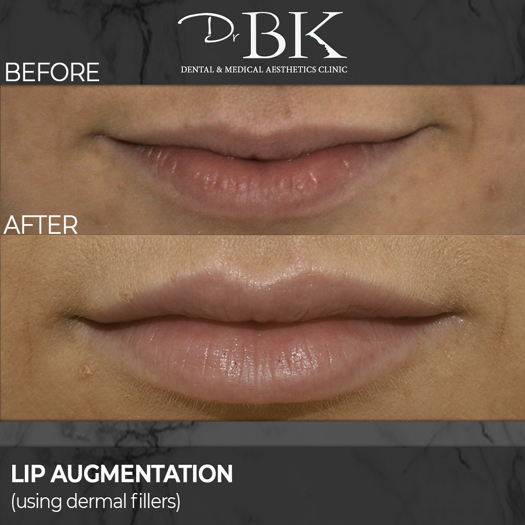 Lip Augmentation: Before & After