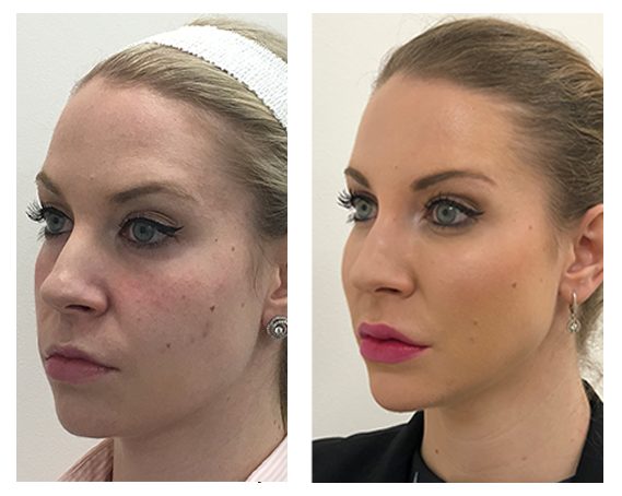 Full Face Treatment: Tear Troughs, Cheeks, Chin, Lips, PRP for Skin