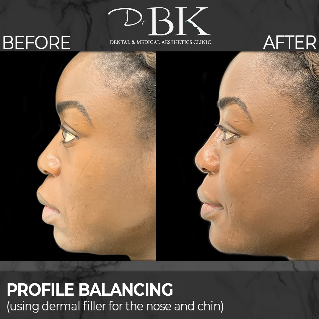 Profile Balancing: Dermal fillers for the Nose and Chin