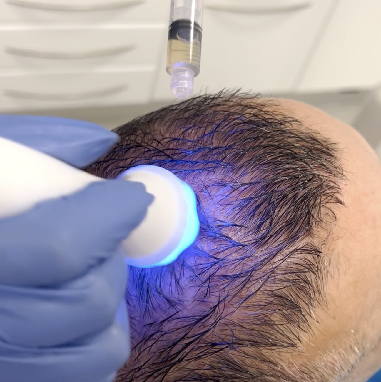 mesoporation for anti-hair loss