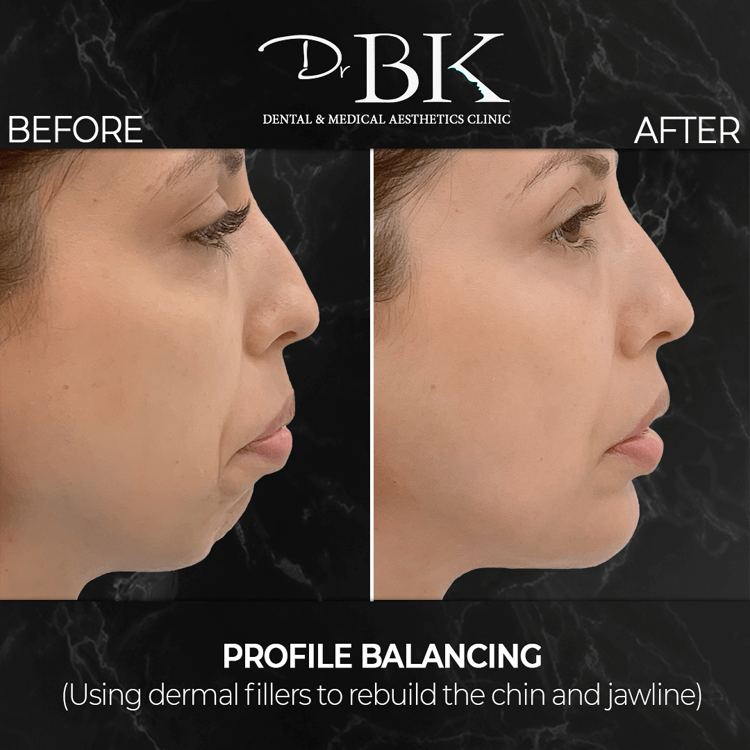 Chin & Jawline Augmentation (using dermal fillers) at DrBK - Before and After Transformation