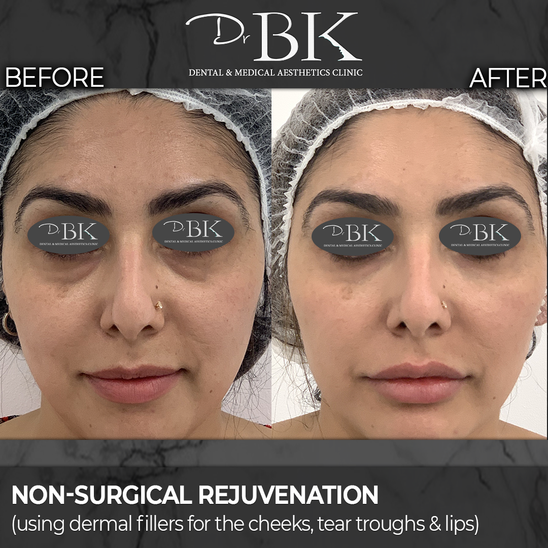 Full Face Rejuvenation: Cheeks, tear troughs & lips
