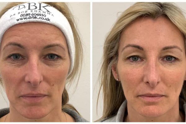 Before & After Cheek Sculpting Before & After Cheek Sculpting