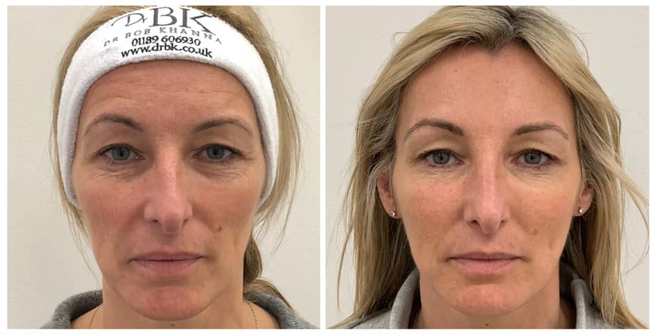 Before & After Full Face Treatment (Mild): Anti-wrinkle treatments, Cheeks & Tear Troughs, Nose, Chin & Skincare